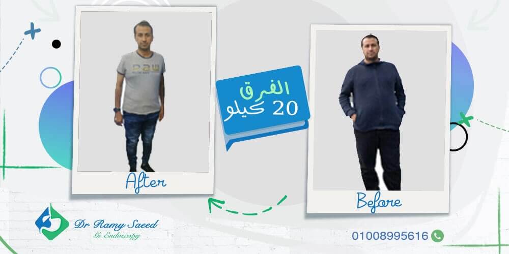 اسعار بالون المعدة في مصر