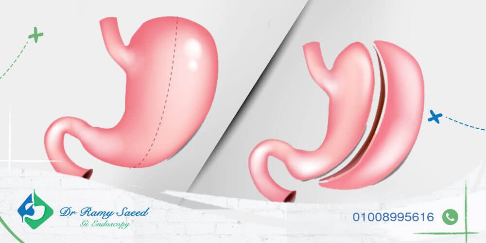 الفرق بين عمليات بالونة المعدة والتكميم